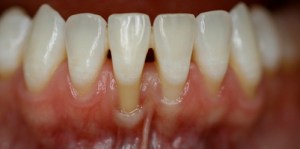 gum recession. Dr. Love