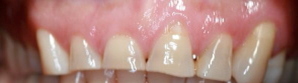 Dr Ellie Love - Periodontal Procedures Before