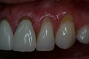 Exposed roots, long teeth