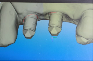 iTero is a revolutionary new technique, which is used to create dental impressions