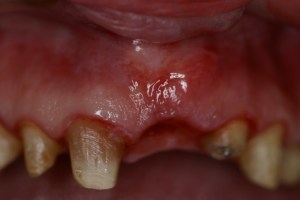 after ridge augmentation treatment