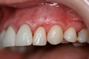 Long teeth, exposed root treatment