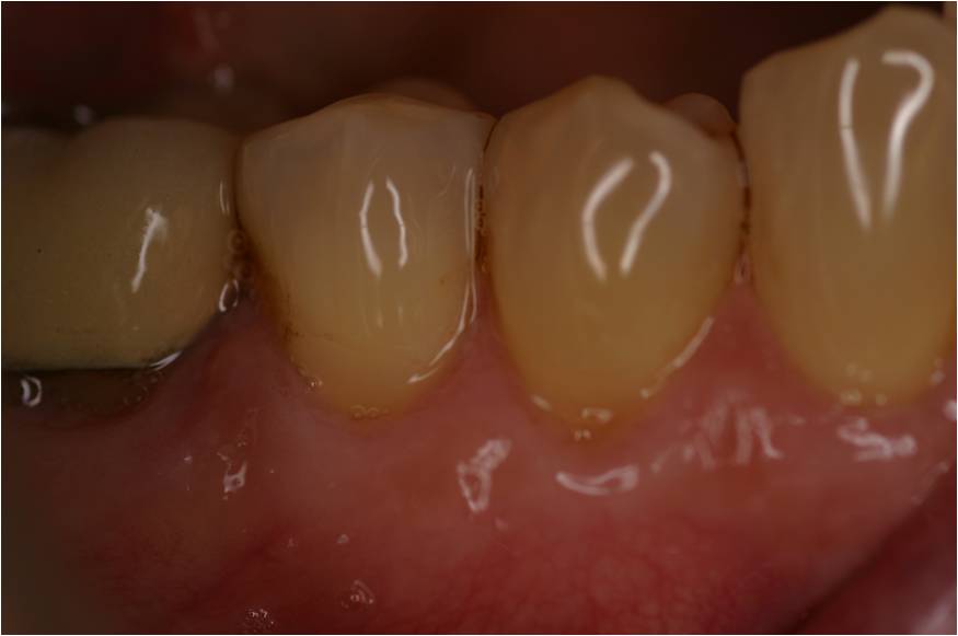 connective tissue grafting