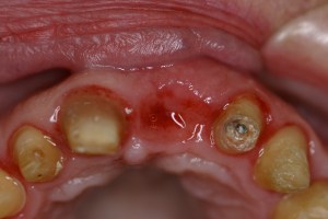 another before dental implants image