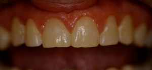 Uneven gum line treatment