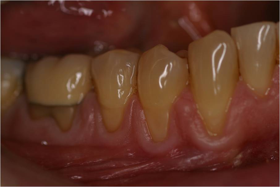 gum recession before surgery
