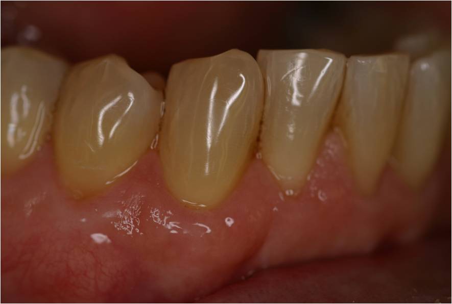 gum recession after surgery