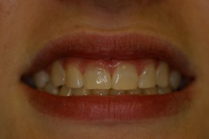 Periodontal Procedures Before