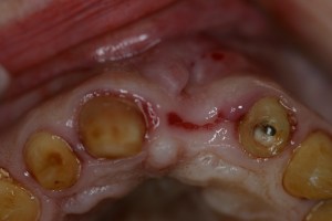 before ridge augmentation