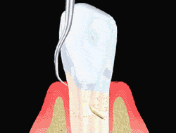 smooth the root surface with planing