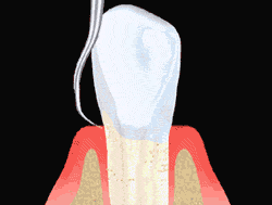 dental root planing & scaling