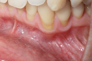 Pinhole gum rejuvenation