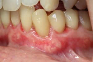 pinhole gum rejuvenation after