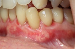 pinhole gum rejuvenation after