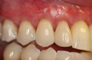 Pinhole gum treatment after