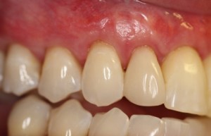 Pinhole gum treatment after
