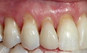 Dr Ellie Love Pinhole Gum Rejuvenation
