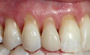 Dr Ellie Love Pinhole Gum Rejuvenation
