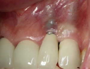 dental implant before gum rejuvenation