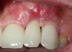 dental implant after gum rejuvenation treatment