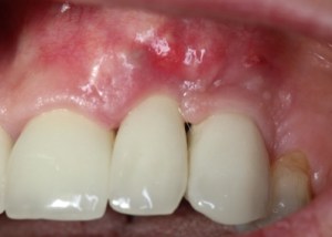 dental implant after gum rejuvenation treatment