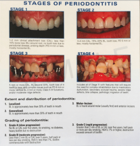 Stages of Periodontitis